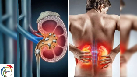 kidney-stones.png